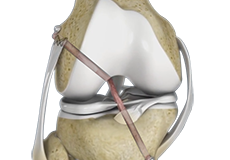 Ligament Reconstruction