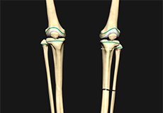 Limb Lengthening