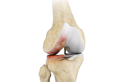 Osteoarthritis Management